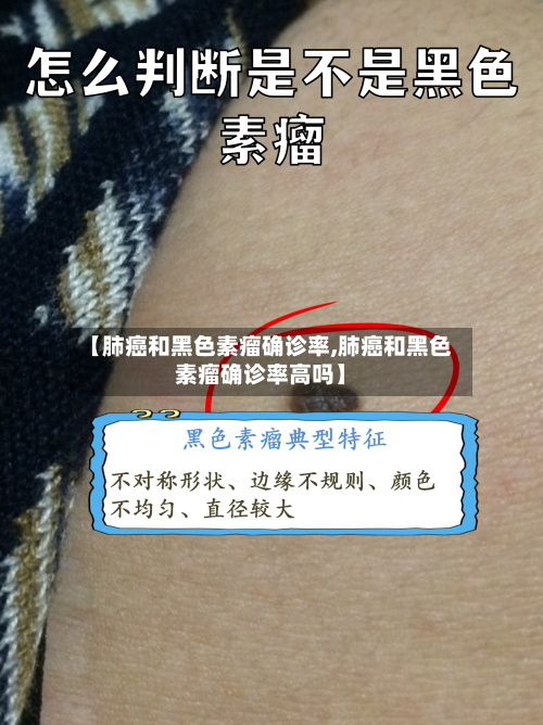 【肺癌和黑色素瘤确诊率,肺癌和黑色素瘤确诊率高吗】-第2张图片