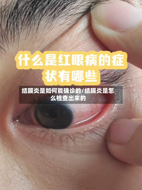 结膜炎是如何能确诊的/结膜炎是怎么检查出来的-第3张图片