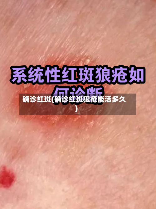 确诊红斑(确诊红斑狼疮能活多久)