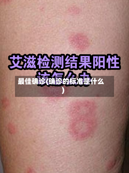 最佳确诊(确诊的标准是什么)