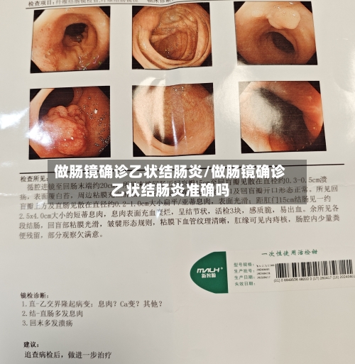 做肠镜确诊乙状结肠炎/做肠镜确诊乙状结肠炎准确吗-第3张图片