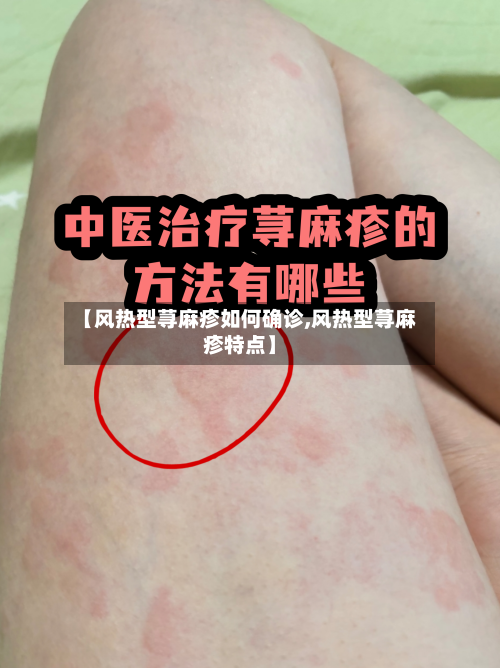 【风热型荨麻疹如何确诊,风热型荨麻疹特点】-第3张图片