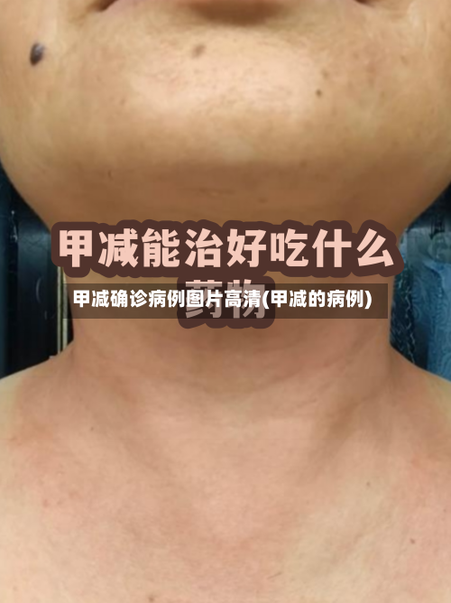 甲减确诊病例图片高清(甲减的病例)