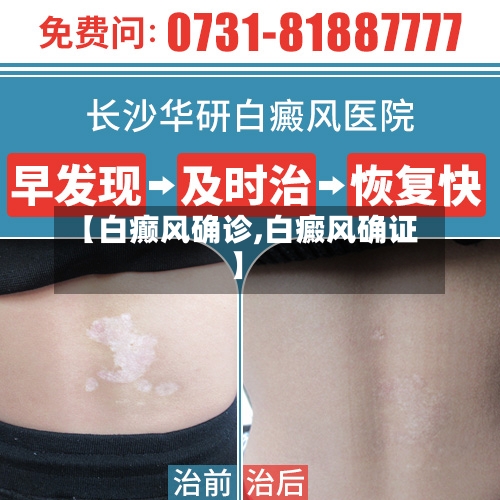 【白癫风确诊,白癜风确证】