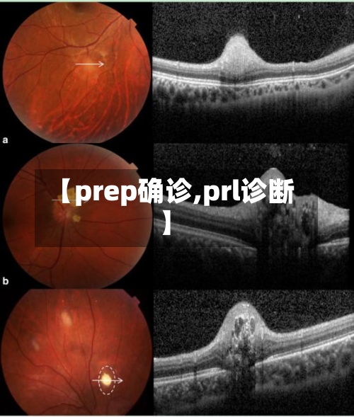 【prep确诊,prl诊断】