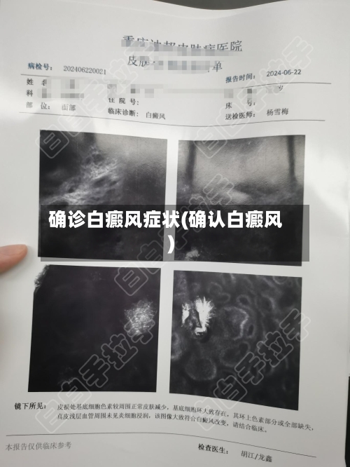 确诊白癜风症状(确认白癜风)