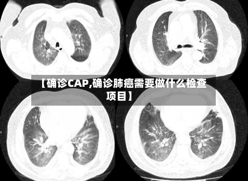 【确诊CAP,确诊肺癌需要做什么检查项目】-第3张图片