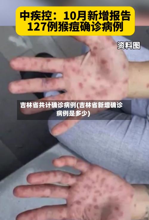 吉林省共计确诊病例(吉林省新增确诊病例是多少)-第3张图片
